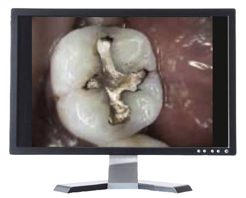 Live-Aufnahme der Carestream CS 1500, intraorale Kamera